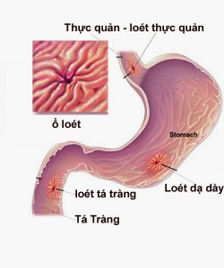 nguy cơ ung thư dạ dày cao