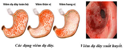 Résultat de recherche d'images pour "viêm dạ dày"