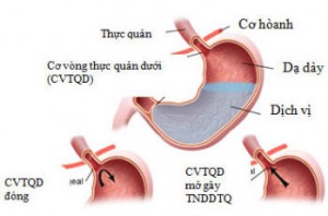những điều cần biết về bệnh trào ngược dạ dày thực quản
