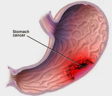 Những cách xử lý bệnh viêm loét dạ dày