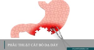 Phẫu thuật cắt bỏ dạ dày