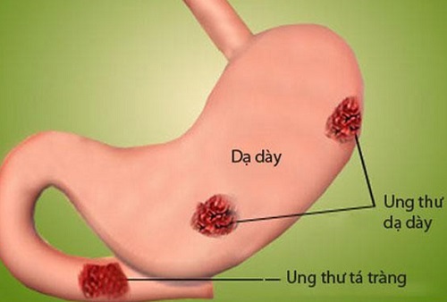 Viêm xung huyết dạ dày có nguy hiểm không?