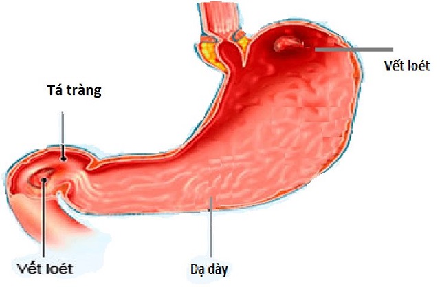 Đau nóng rát vùng thượng vị