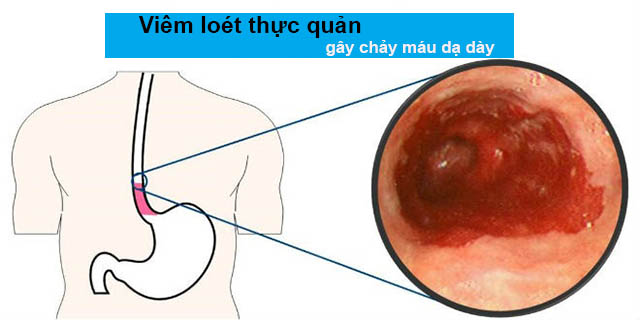 Viêm loét thực quản gây xuất huyết dạ dày