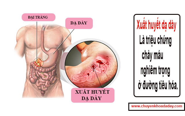 Xuất huyết dạ dày