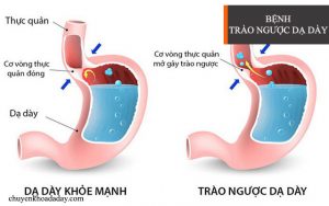 Trào ngược dạ dày thực quản có thể dẫn đến ung thư thực quản