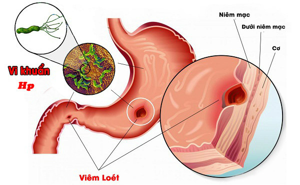 Vi khuẩn HP gây viêm loét dạ dày