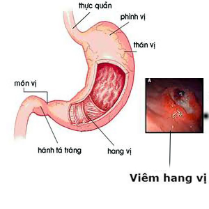 Cách chuẩn đoán viêm hang vị dạ dày