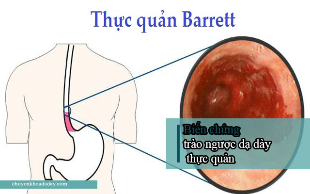 biến chứng trào ngược dạ dày thực quản