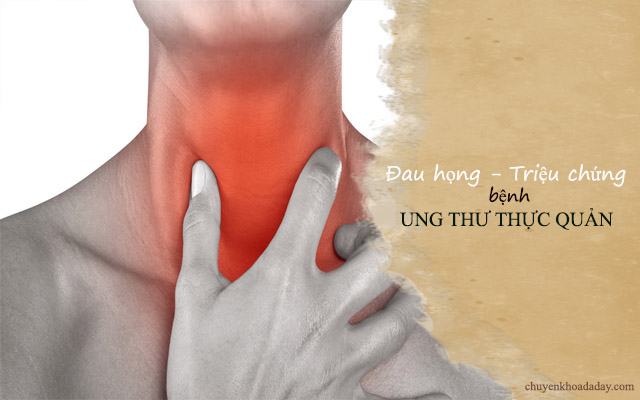 Đau họng kéo dài là một trong những dấu hiệu của bệnh ung thư thực quản