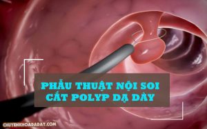Phẫu thuật nội soi cắt Polyp dạ dày