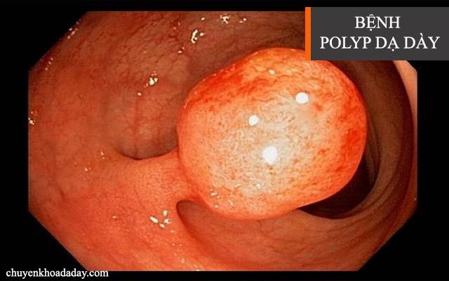 Bệnh polyp trong dạ dày