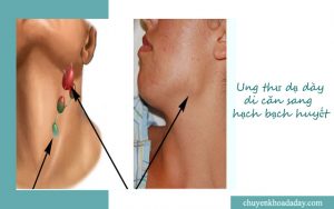 Ung thư dạ dày di căn đến hạch bạch huyết