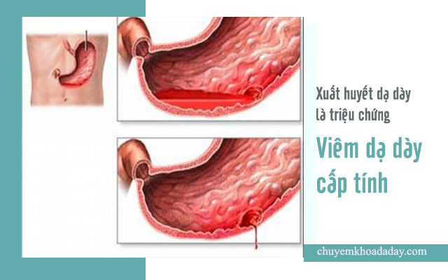 dấu hiệu viêm dạ dày cấp tính