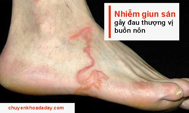 Nhiễm giun sán gây đau thượng vị buồn nôn