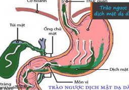 Chứng trào ngược dịch mật dạ dày