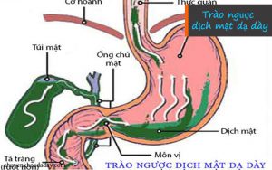 Chứng trào ngược dịch mật dạ dày