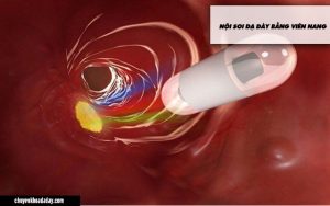 Nội soi dạ dày bằng viên nang