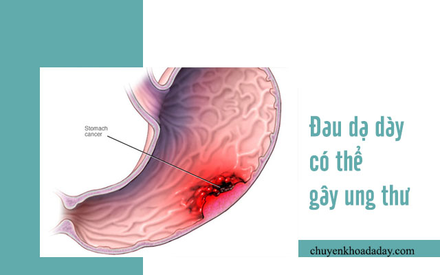 biến chứng đau dạ dày