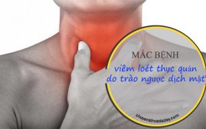 Trào ngược dịch mật dễ dẫn đến bệnh viêm loét thực quản
