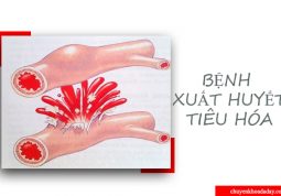 Triệu chứng bệnh xuất huyết tiêu hóa