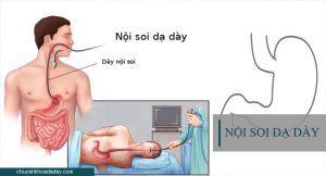 Quy trình thực hiện nội soi dạ dày có gây mê