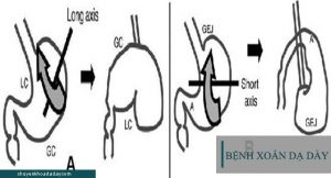 Xoắn dạ dày gây ảnh hưởng nghiêm trọng đến sức khỏe người bệnh