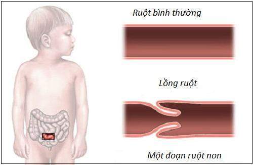 Dấu hiệu nhận biết sớm bệnh lồng ruột ở trẻ em-2