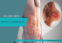 Dấu hiệu của chứng thoát vị thành bụng