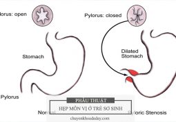 Chứng hẹp môn vị dạ dày ở trẻ sơ sinh