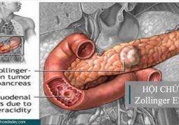 Hội chứng Zollinger Ellison