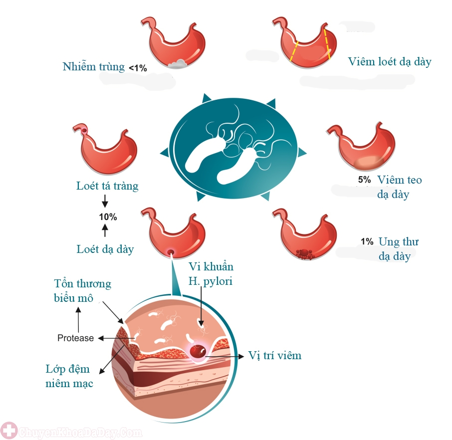 Vi khuẩn H.py;ori có thể gây ra nhiều ảnh hưởng cho sức khỏe dạ dày