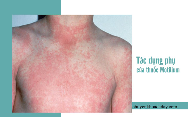 tác dụng phụ của thuốc Motilium