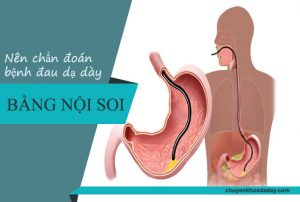 Nên dùng phương pháp nội soi để chẩn đoán bệnh đau dạ dày