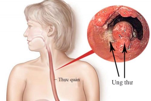 Sơ can bình vị tán - Bài thuốc “khắc tinh" của trào ngược dạ dày thực quản