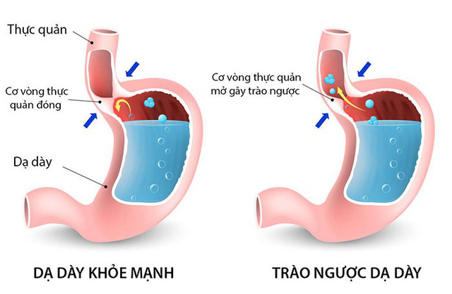 nguyên nhân gây trào ngược dạ dày