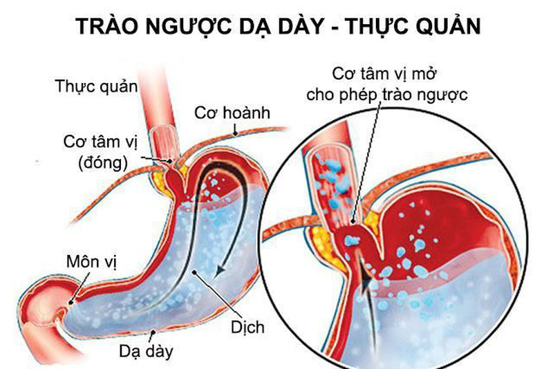 Trào ngược dạ dày là gì