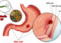 Dấu hiệu nhiễm khuẩn HP rất giống với các bệnh dạ dày khác nên cần thăm khám để phân biệt đúng