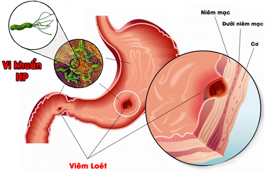 Dấu hiệu nhiễm khuẩn HP rất giống với các bệnh dạ dày khác nên cần thăm khám để phân biệt đúng