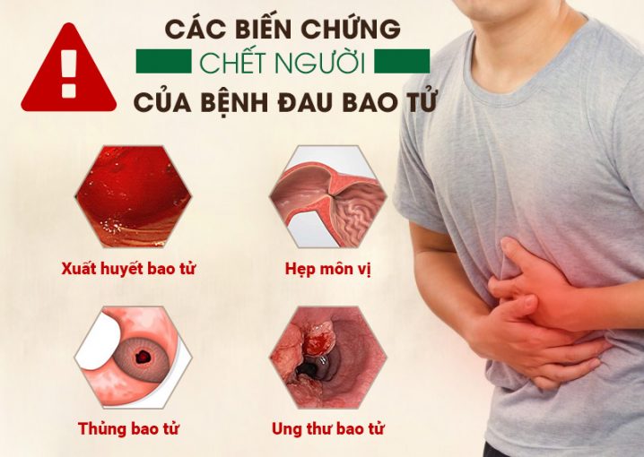 Người bệnh đau bao tử có thể mắc biến chứng nguy hiểm tới tính mạng nếu không điều trị sớm, kịp thời